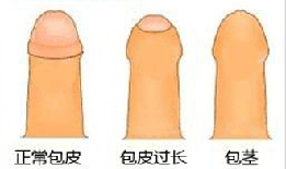 仁济男科看包皮过长