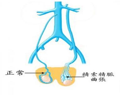 精索静脉曲张的危害,<a class='link_keywords' href='http://www.yjrj120.com/'>阳江仁济医院</a> 